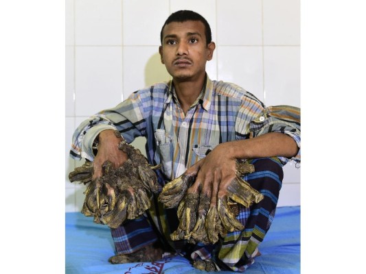 Abul Bajandar , de 26 años, apodado Árbol Man.