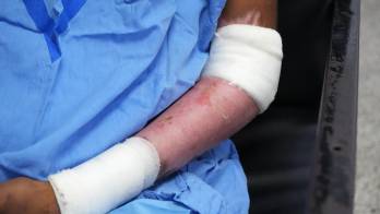 “No existen artefactos pirotécnicos ‘inofensivos’, expresó Marvis Corro, jefa de la Unidad de Quemados del Hospital del Niño José Renán Esquivel.