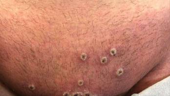 Una semana sin nuevos casos de viruela símica