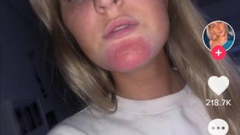 Rubia quedó con una extraña infección en la cara por la barba sucia de su novio