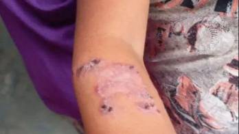 El diagnóstico de la leishmaniasis se realiza mediante el análisis de muestras de tejido infectado.