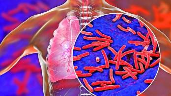 El último informe para el año 2021, registró una incidencia de casos de 1,322.