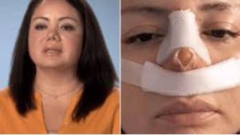 Se hizo liposucción y salió con nariz nueva