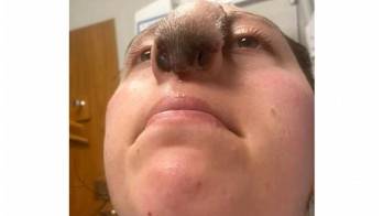 Un perro le mordió la cara y ahora le sale pelo en la nariz