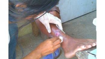 Casos de&nbsp;Leishmaniasis siguen en aumento