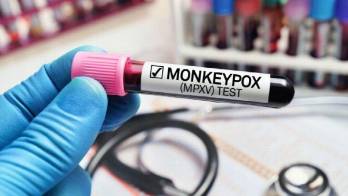 Panamá sin casos activos de viruela símica