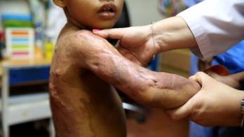 A los pacientes se les da la rehabilitación en la sala de fisioterapia una vez que las heridas se han cicatrizado.