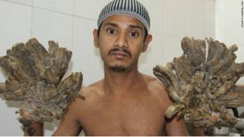 ‘El hombre árbol' está grave, tenía que vivir de las limosnas