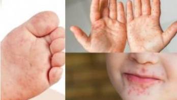 El virus suele aparecer con sarpullido en las manos y pies, y llagas en la boca.