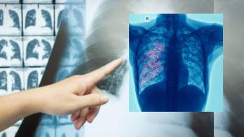 El cáncer de pulmón sigue siendo la principal causa de muerte por cáncer
