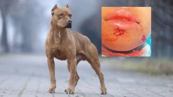 Pitbull de una vecina atacó a su hijo de 11 años y lo mandó al hospital