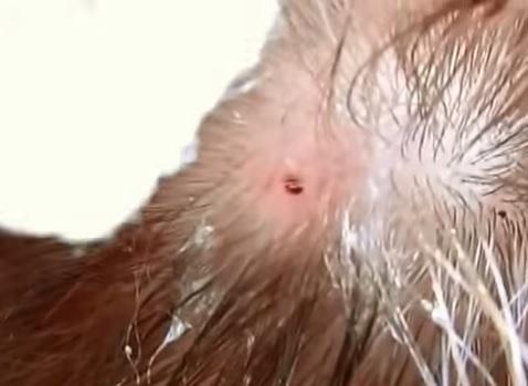 Joven encuentra un gusano en su cabeza después de su viaje a Panamá.