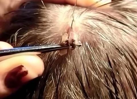 Joven encuentra un gusano en su cabeza después de su viaje a Panamá.