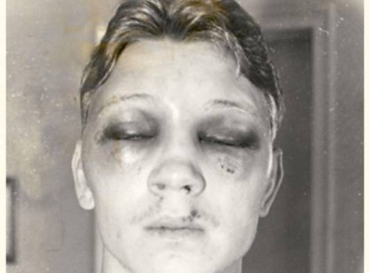 Así quedó el rostro de Collins después de la pelea.