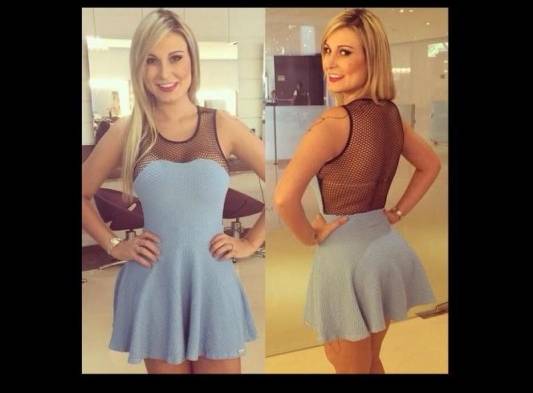 Andressa se&nbsp;inyectó&nbsp;hidrogel&nbsp;hace cinco años para aumentar el volumen de las piernas.