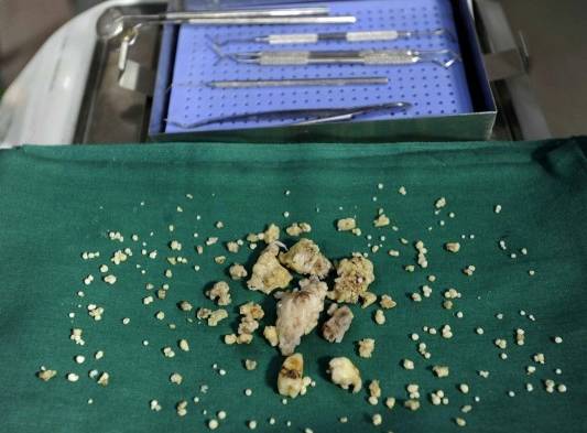 Extraen 232 dientes a joven en la India
