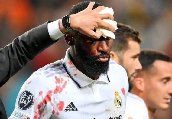 Rüdiger: “Estoy bien” tras recibir 20 puntos de sutura en la frente