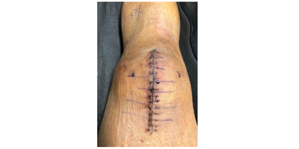 Jerry Rivera fue sometido a una operación en la rodilla tras caerse del escenario