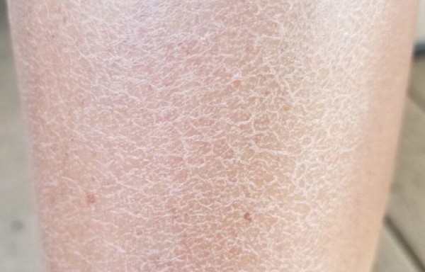 Cómo tratar la piel seca