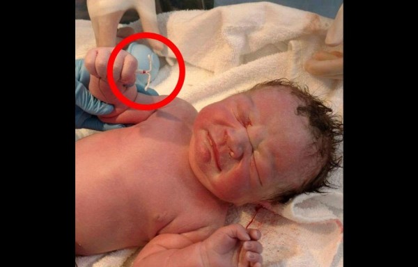 Bebé nace con un DIU en la mano