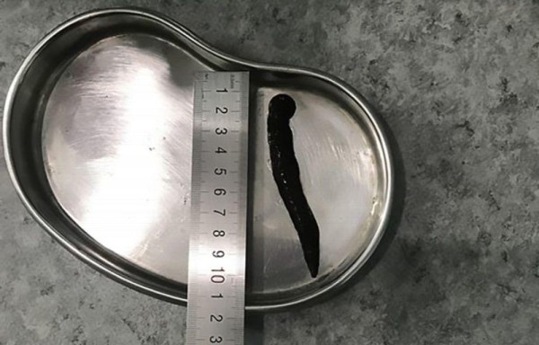 Tosía sangre y resultó ser una sanguijuela