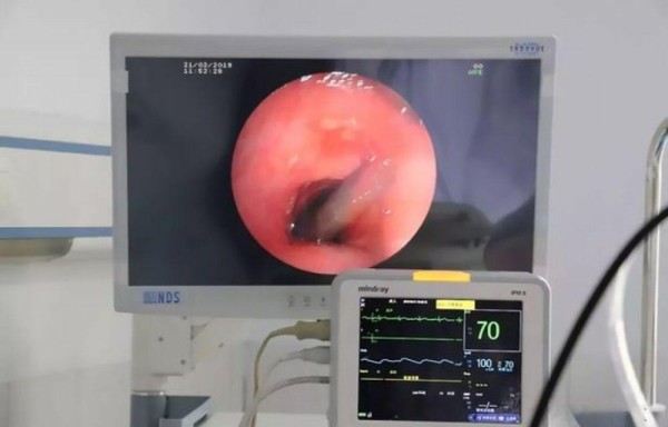 Tosía sangre y resultó ser una sanguijuela