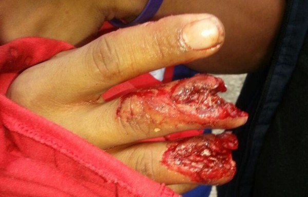 Lamentablemente, un joven perdió varios dedos de la mano.