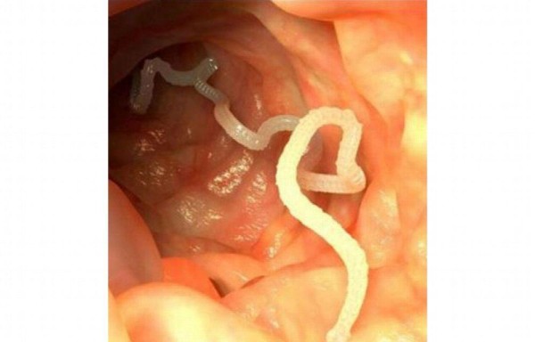 Le sacaron un gusano vivo del cerebro