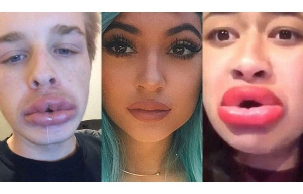 Las chicas y chicos se desfiguran los labios.