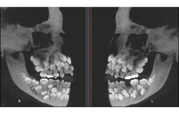Niña de 11 años tenía 81 dientes