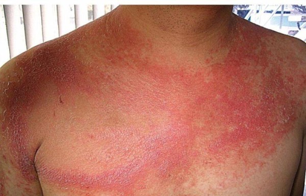 La psoriasis causa dolor, desfiguración y discapacidad a quien la padece.