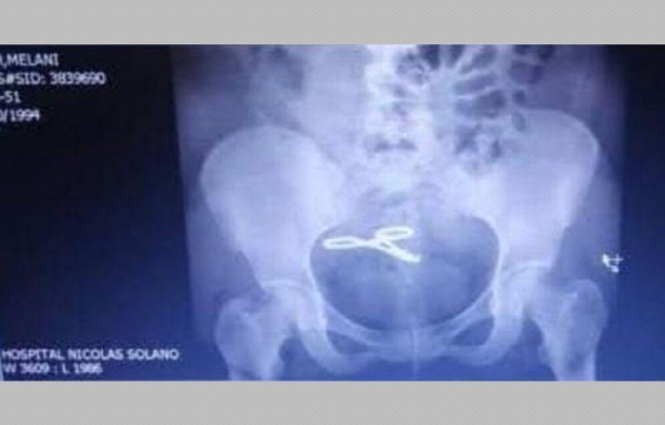 Cuatro años después de su cesárea se percatan que le dejaron una pinza, su caso quedó en nada y Melanie Smith exige justicia.