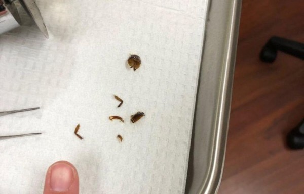 Vivió con una cucaracha en su oído por una semana