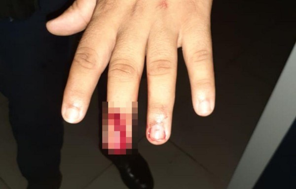 Uno de los policías fue herido en uno de sus dedos
