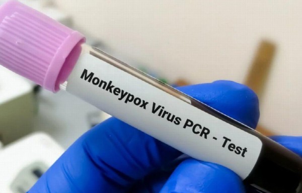 Casos de viruela aumentan a 225 infectados