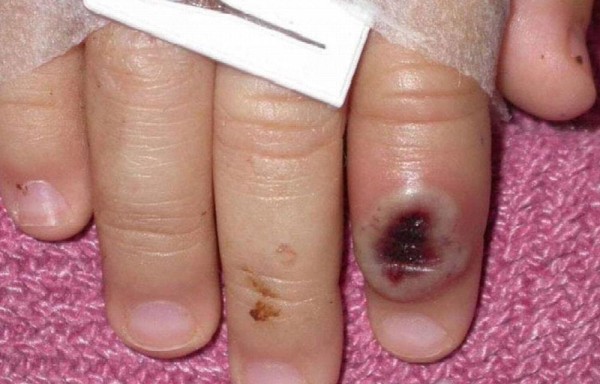 Hay 41 casos activos de esta enfermedad.