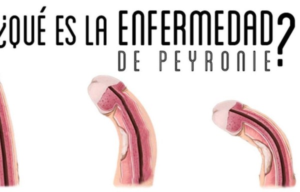 Problemas por tener el pene torcido