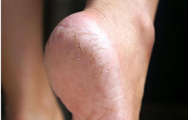 Libres de talones agrietados