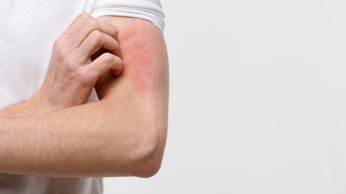 La dermatitis atópica: un impacto profundo en el bienestar social y emocional