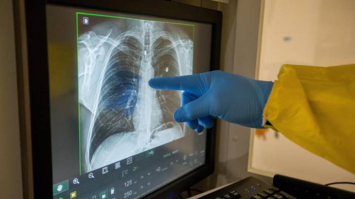 Garantizar el acceso a la salud respiratoria en América Latina sigue siendo un desafío, según reconocieron este jueves especialistas que participaron en el foro 'Salud pulmonar.