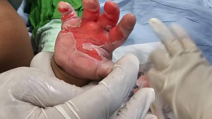 La mayor cantidad de quemaduras infantiles ocurre por líquidos calientes.