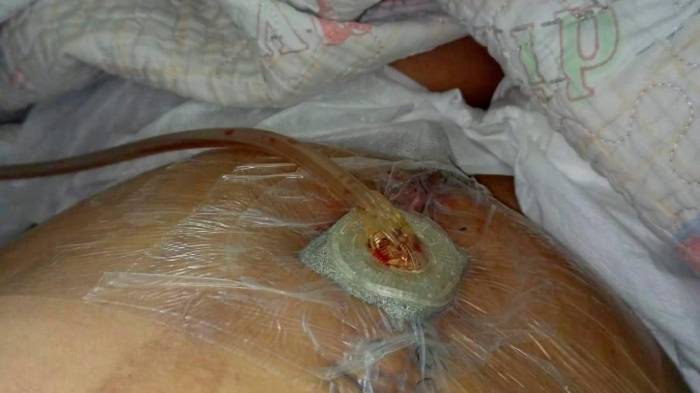 Cirugía fallida: La trágica historia de Yaribeth Murillo