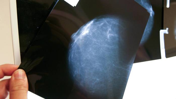 Prueba radiológica en Bilbao (España).