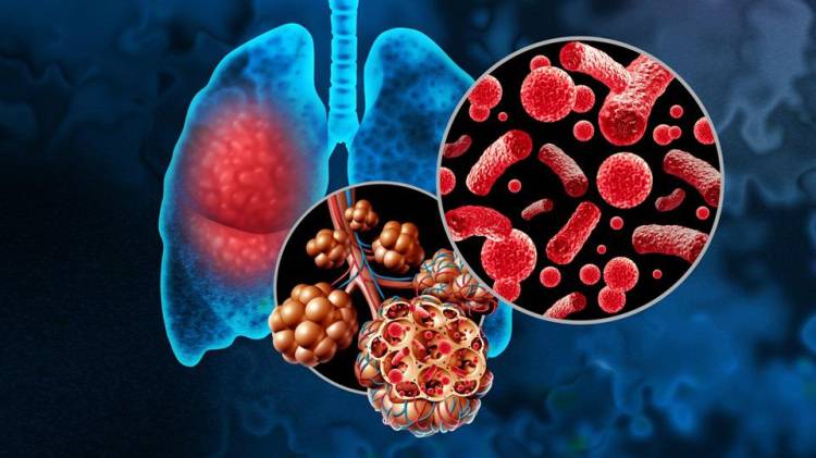 Bacterial Pneumonia or Pneumonia In the Lungs and Pulmonary alveoli with fluid or alveolus inflammation anatomy diagram as a medical concept of a lung anatomy and respiratory disease.