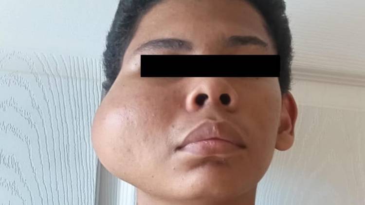 La lucha de un adolescente contra un agresivo tumor maxilofacial
