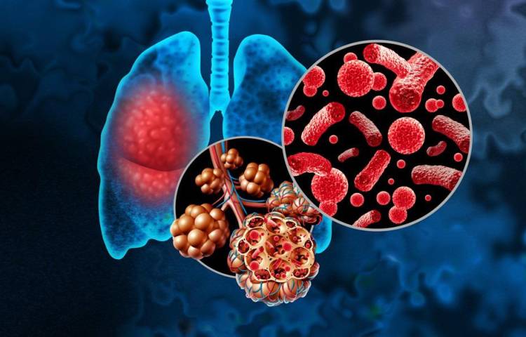 Bacterial Pneumonia or Pneumonia In the Lungs and Pulmonary alveoli with fluid or alveolus inflammation anatomy diagram as a medical concept of a lung anatomy and respiratory disease.