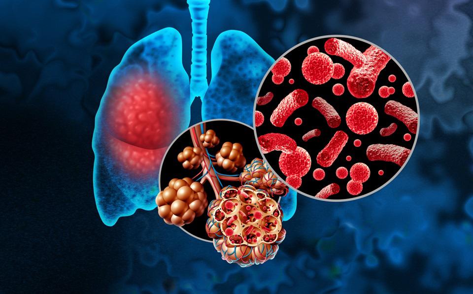 Bacterial Pneumonia or Pneumonia In the Lungs and Pulmonary alveoli with fluid or alveolus inflammation anatomy diagram as a medical concept of a lung anatomy and respiratory disease.